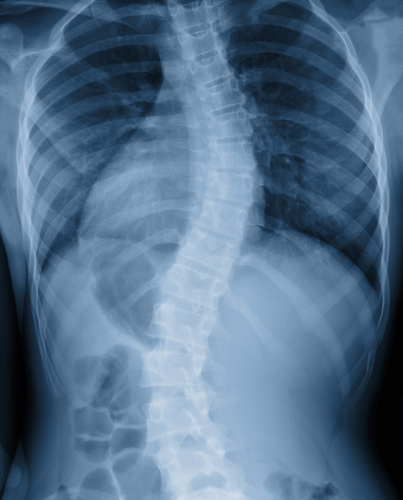 Scoliosi radiografia